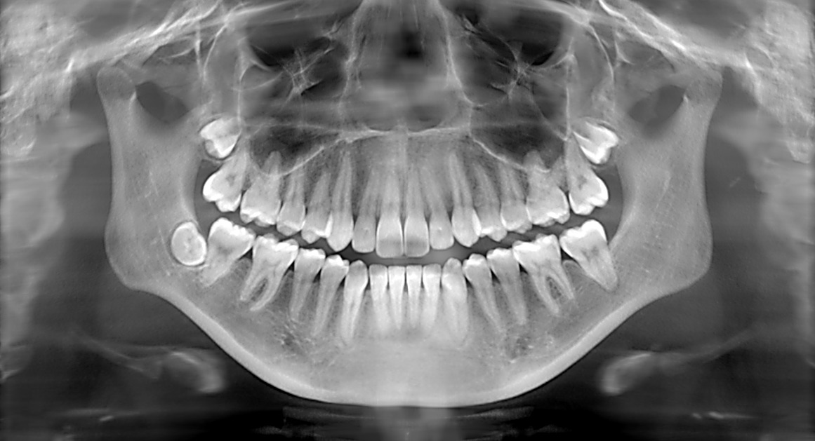 Dental X ray