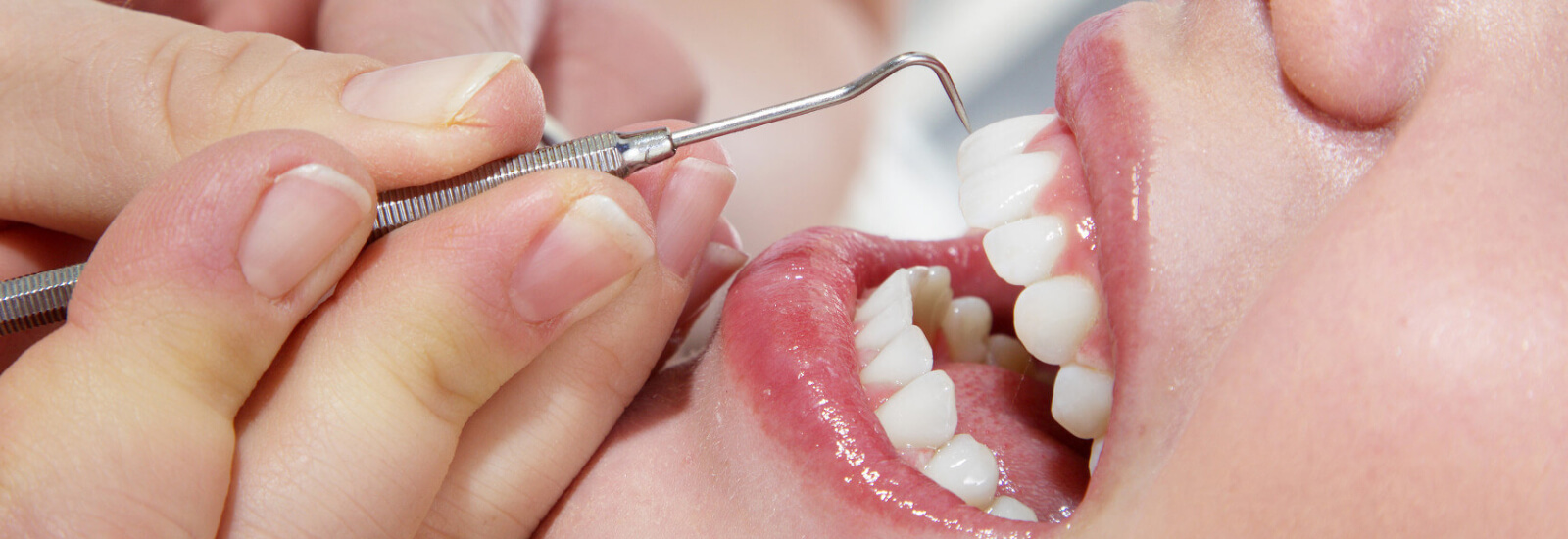 Teeth Scaling Treatment
