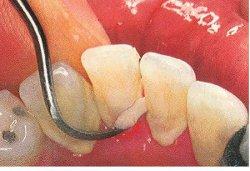 Teeth Scaling Treatment